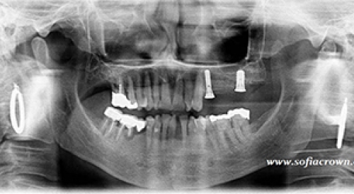 Clinical case - implantology