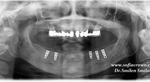 Clinical case-implantology